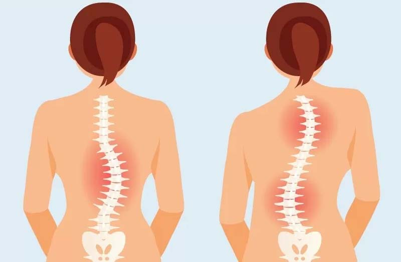 Cong vẹo cột sống là bệnh lý điển hình ở giới trẻ gây đau lưng giữa