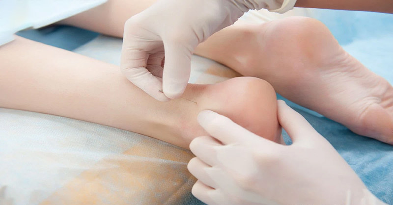 Châm cứu huyệt Côn Lôn chỉ nên thực hiện bởi chuyên gia