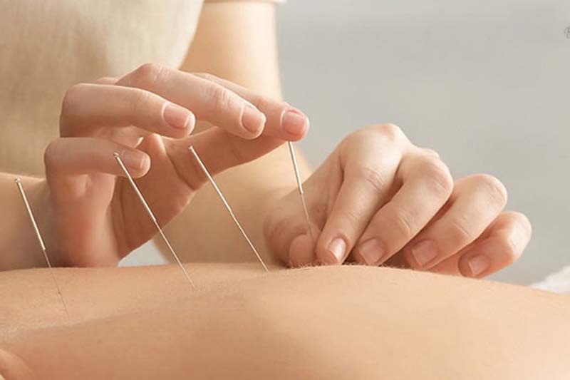 Châm cứu huyệt Đởm Du bằng kim châm chuyên dụng