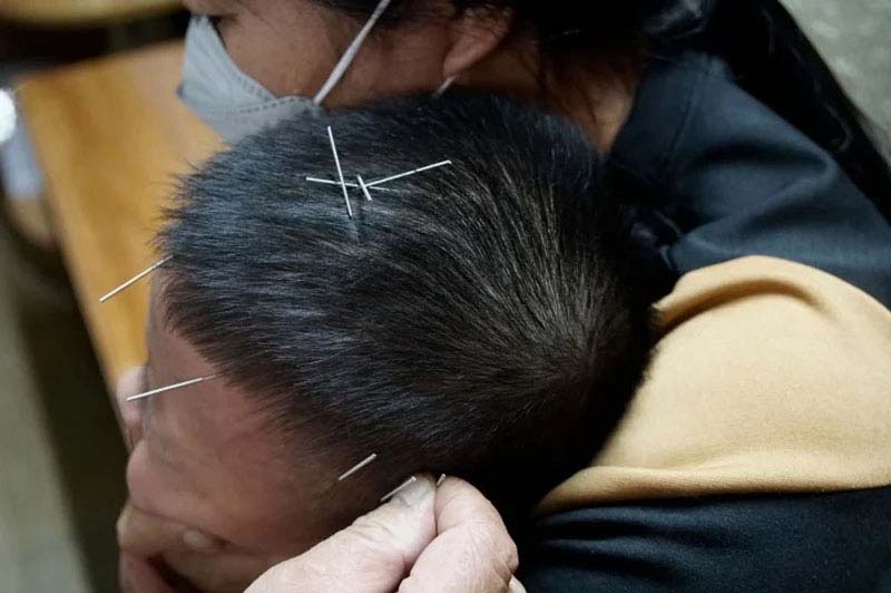 Châm cứu huyệt Tứ Thần Thông kèm các huyệt vị khác