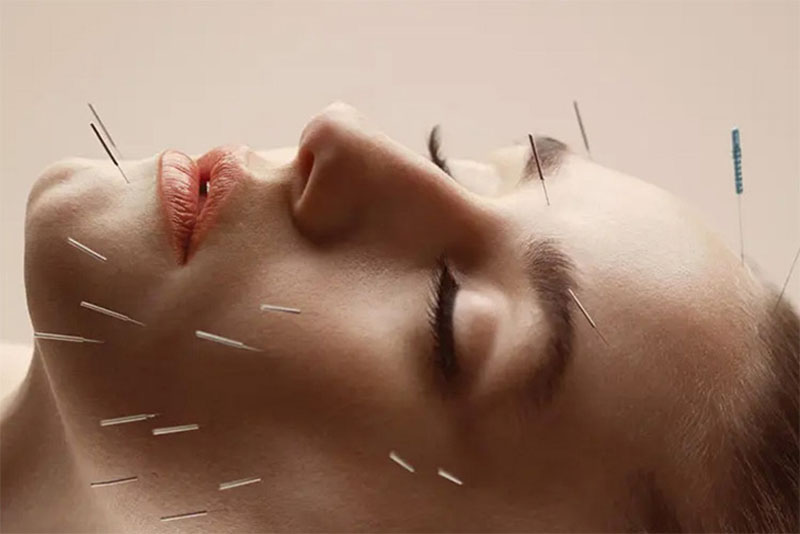 Châm cứu huyệt Thừa Tương kết hợp với các huyệt khác trên mặt