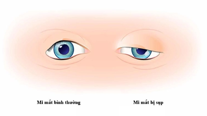 Có nhiều nguyên nhân gây sụp mi