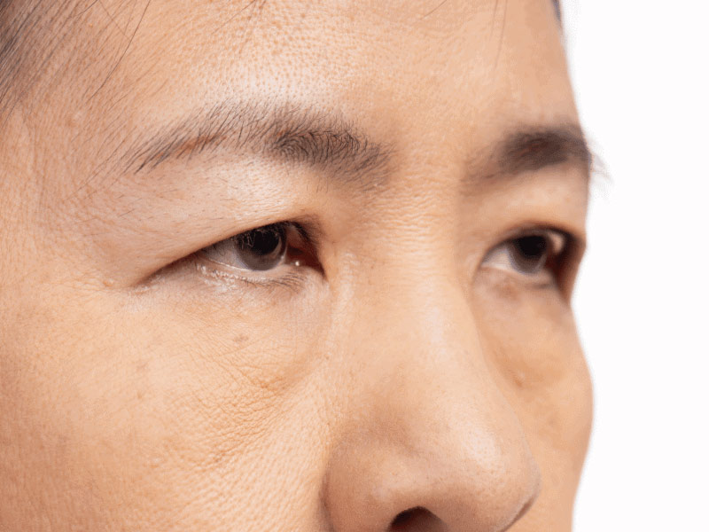 Bấm huyệt chữa sụp mi mắt giúp nâng mí, giải quyết nguyên nhân gây sụp mi