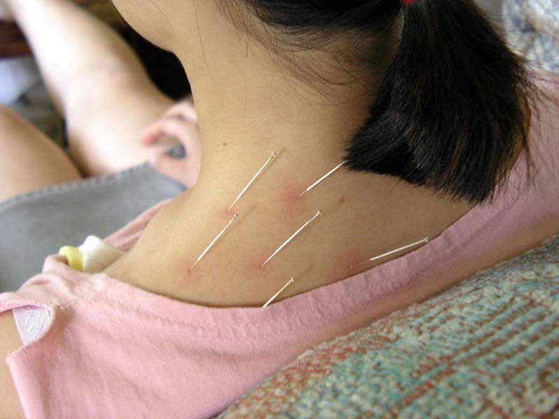 Châm cứu huyệt Kiên Tỉnh kết hợp cùng các huyệt vị khác gia tăng hiệu quả điều trị bệnh