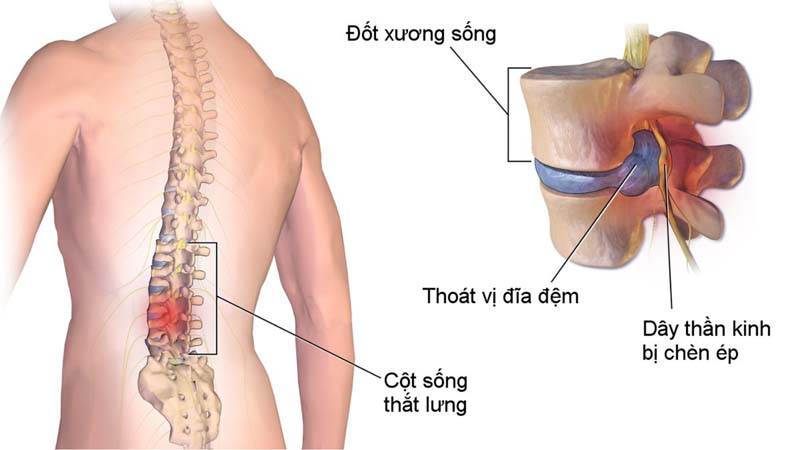 Thoát vị đĩa đệm chèn ép dây thần kinh gây hiện tượng tê chân