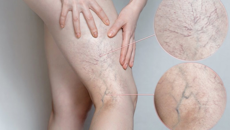 Bệnh suy giãn tĩnh mạch