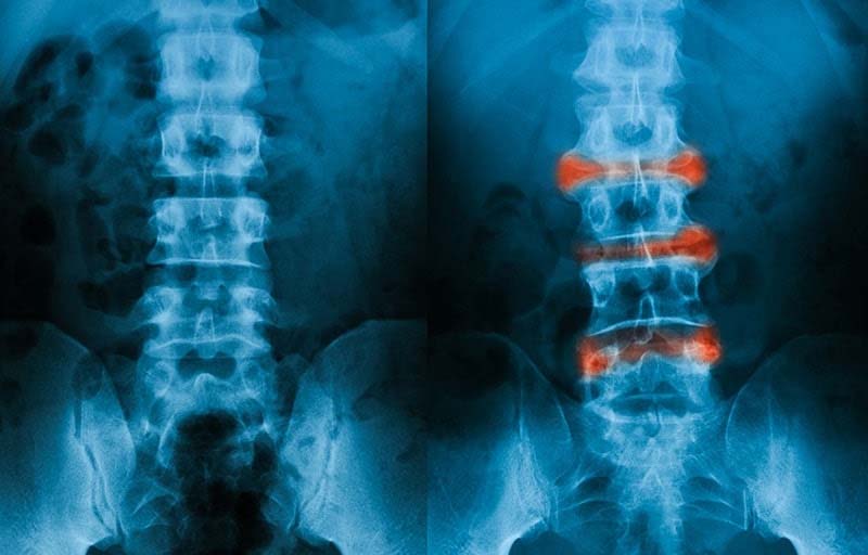 Viêm cột sống dính khớp - Tình trạng điển hình gây ra hội chứng thắt lưng hông