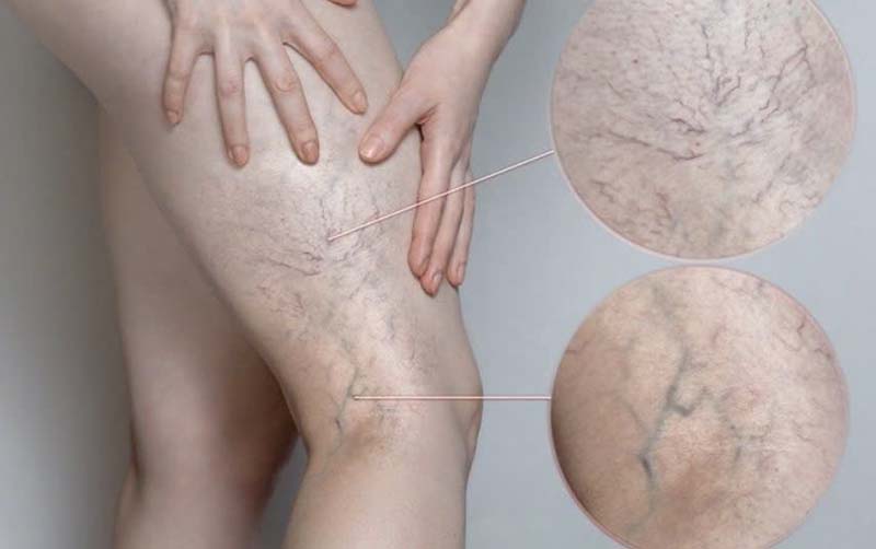 Giãn tĩnh mạch: Nguyên nhân, triệu chứng, cách phòng và điều trị
